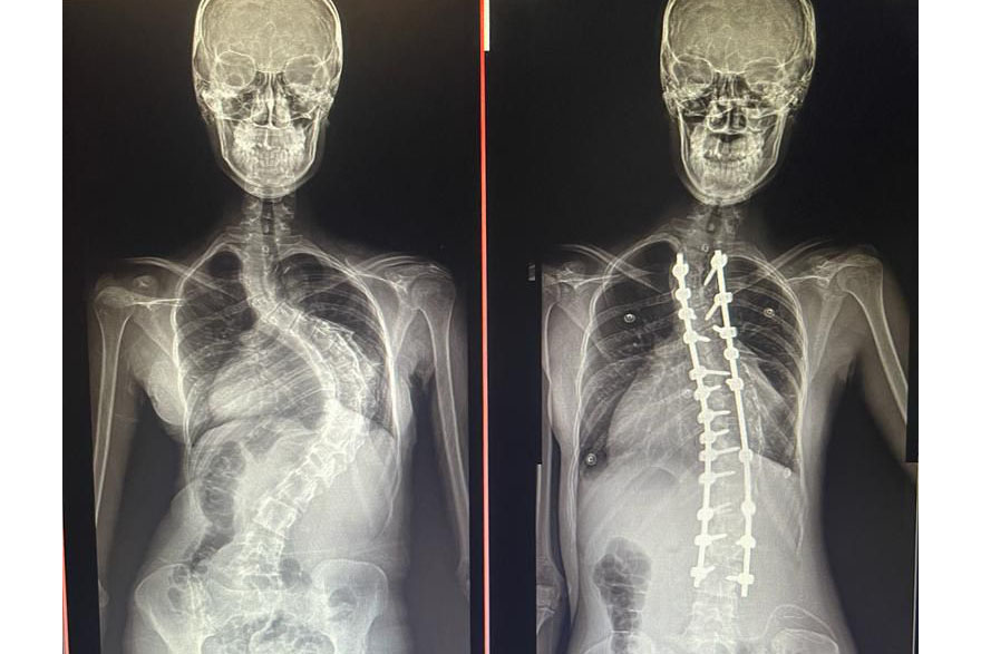 Raio X de paciente com escoliose antes e depois da cirurgia